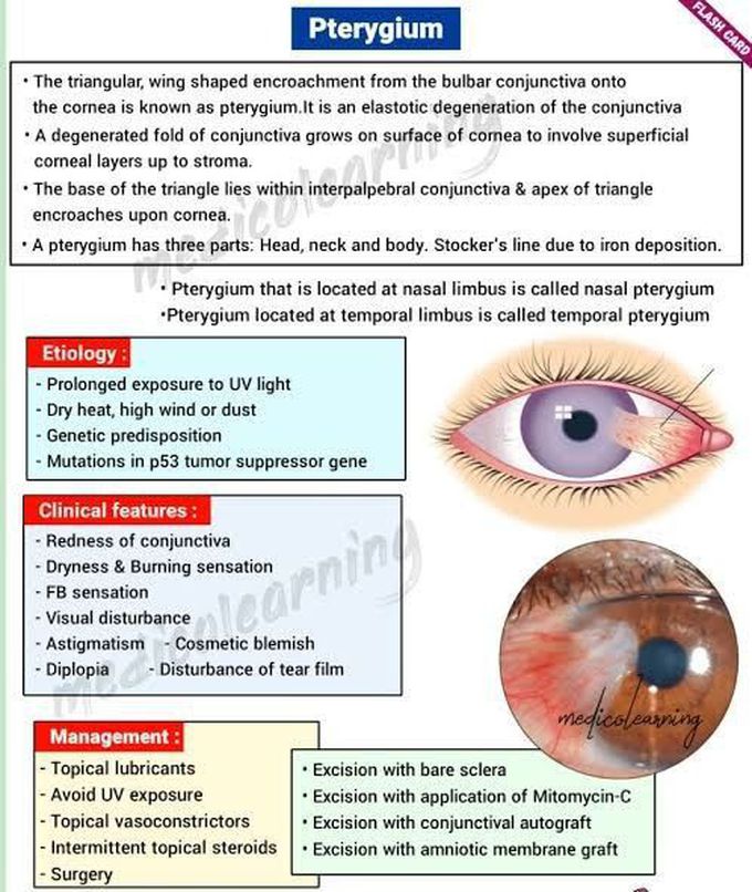 Pterigium