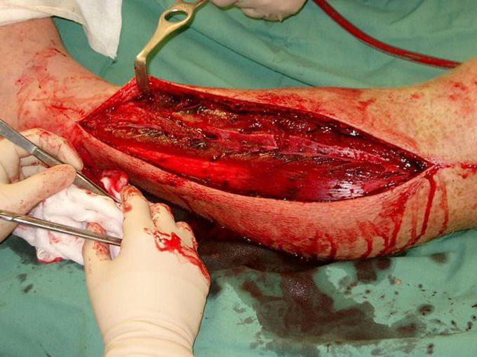 Fasciotomy