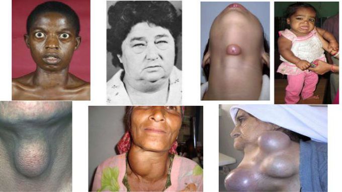 Disorder related to thyroid gland
