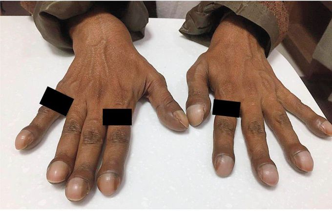 Hepatopulmonary Syndrome