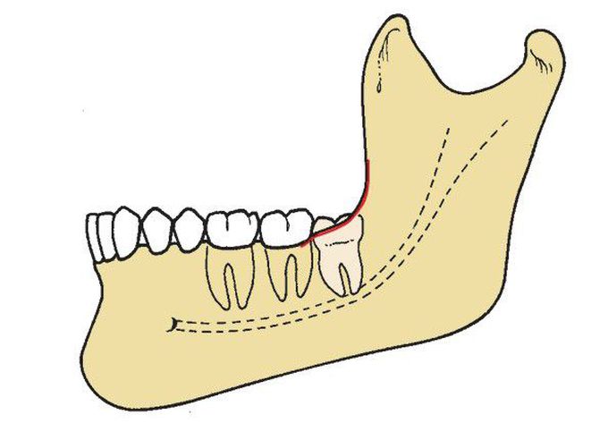 Pell and Gregory class B impaction