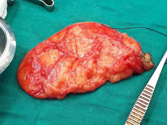 Lipoma