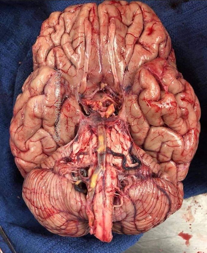 #brain #pathology