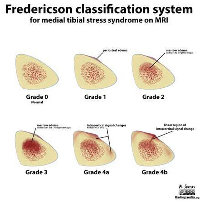 Fredericson Classification of medial tibial stress syndrome