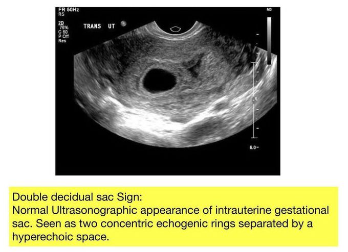 Double Decidual Sac Sign