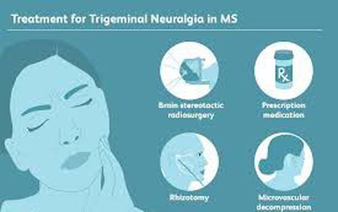 Treatment of trigeminal neuralgia