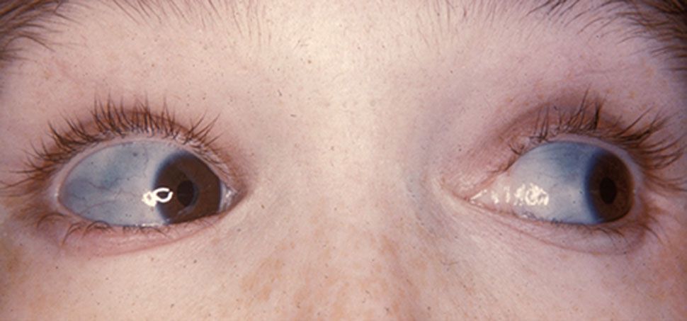 Blue Sclera A Manifestation Of Osteogenesis Imperfecta Medizzy 