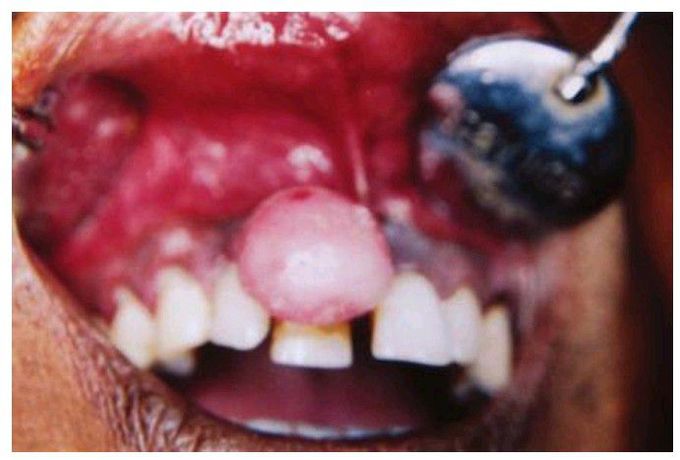 Fibroma