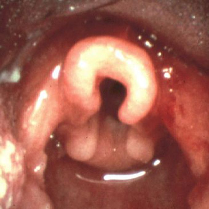 Laryngomalacia