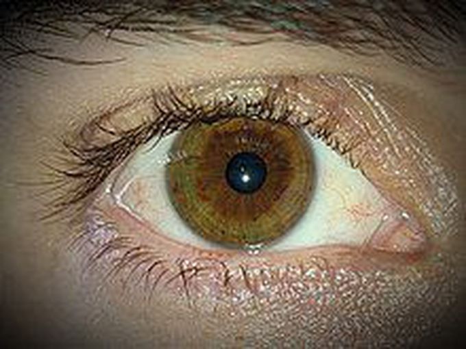 Causes of heterochromia iridis
