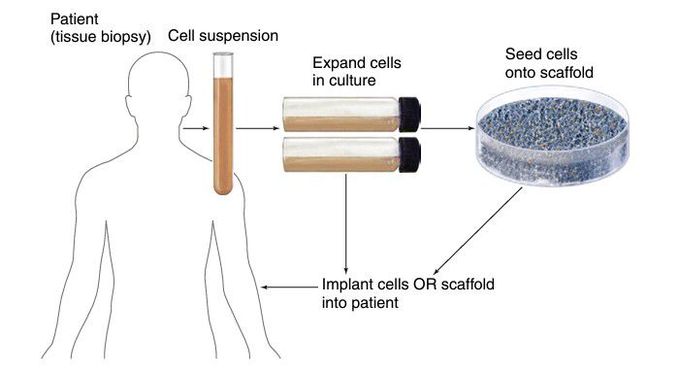 Cell injection therapy