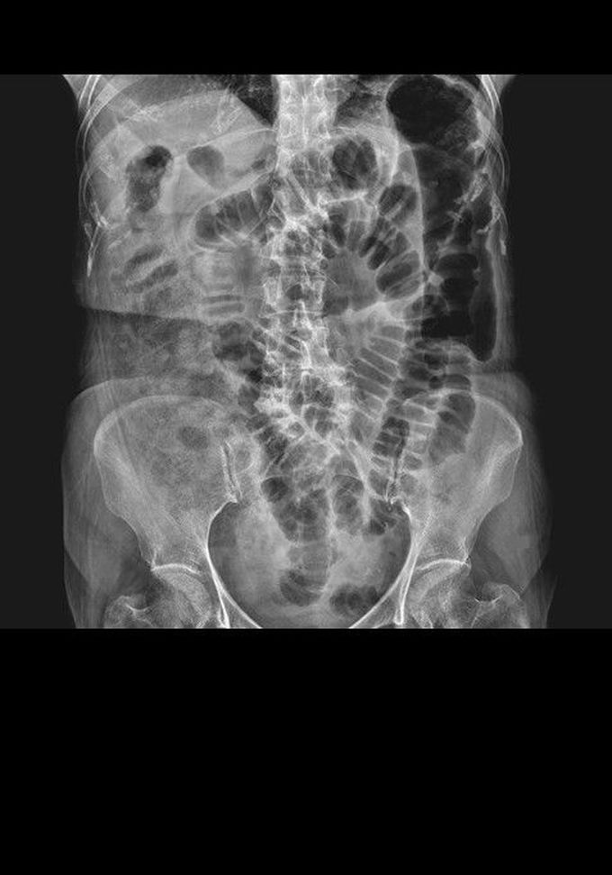 Acute pancreatitis