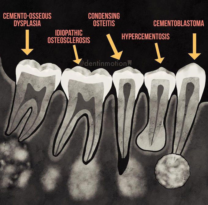 Periapical Radioopacities