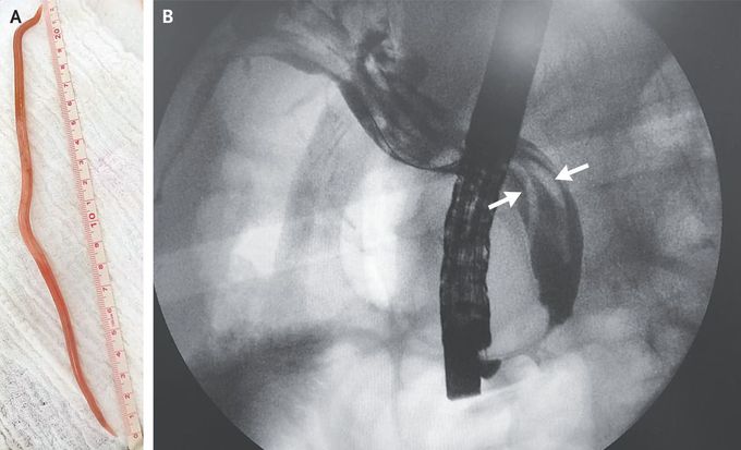 Biliary Ascariasis