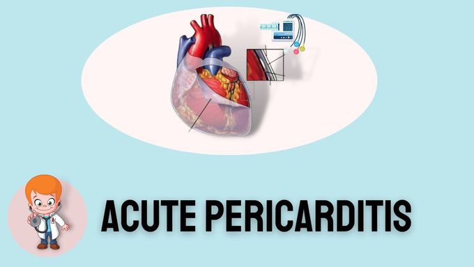 ECG Features of Acute Pericarditis
