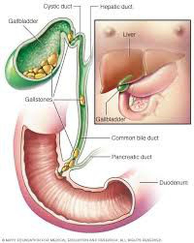 Causes of cholelithiasis