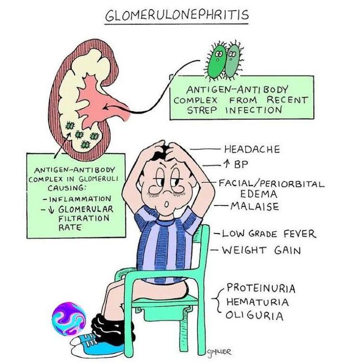 Glomerulonephritis