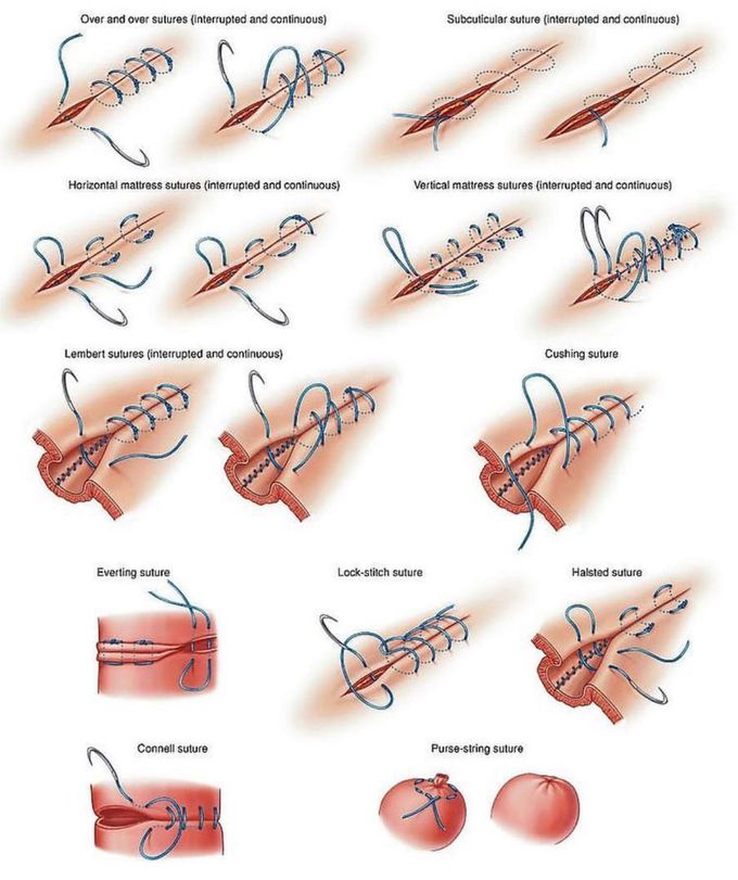 Easy sutures