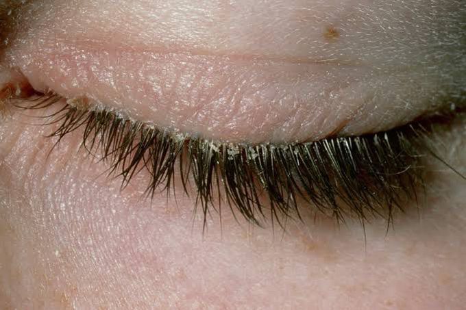 Anterior blepharitis