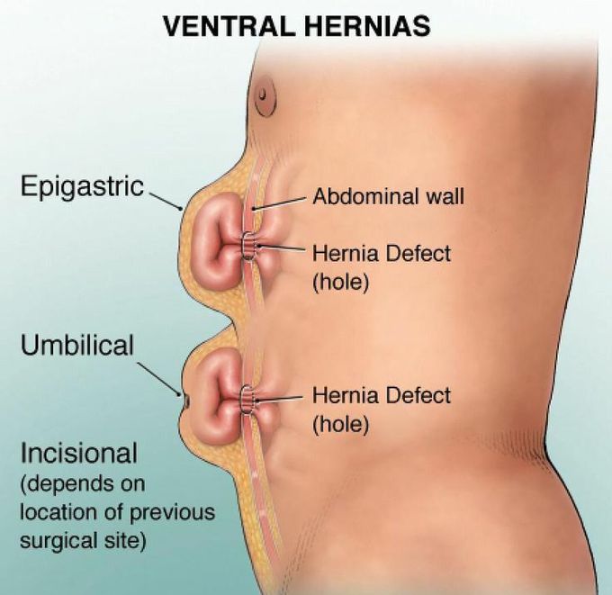 VENTRAL HERNIAS