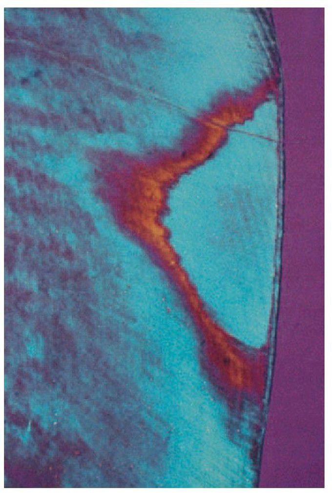 Early interproximal caries