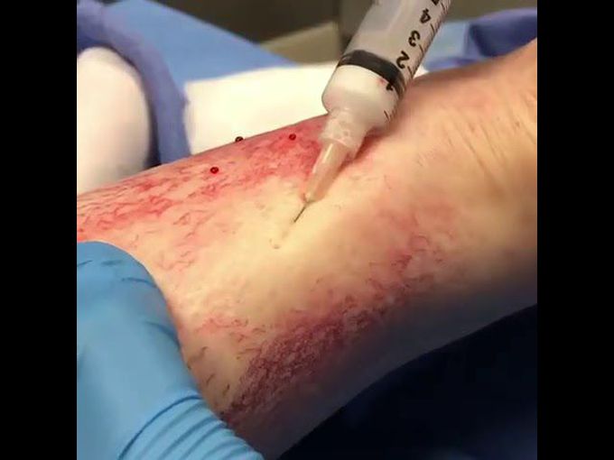 Spider veins (telangiectasias): treatment