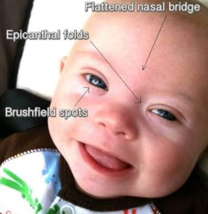 Which of the following is not a feature of downs syndrome....