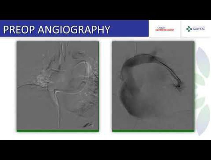 Bilateral Partial Anomalous Pulmonary Venous Connection