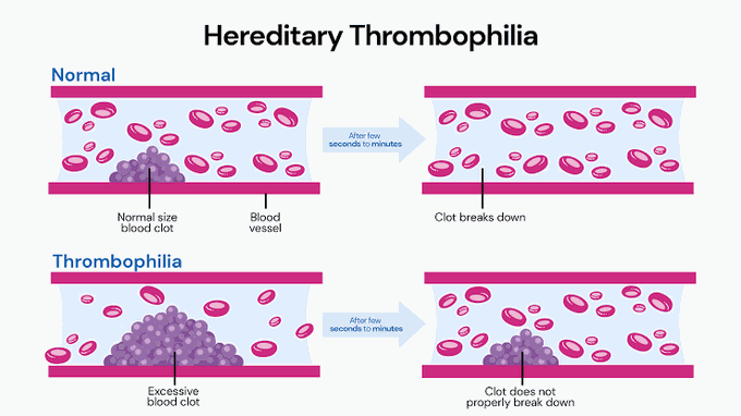 Hereditary Thrombophilia pathogenesis