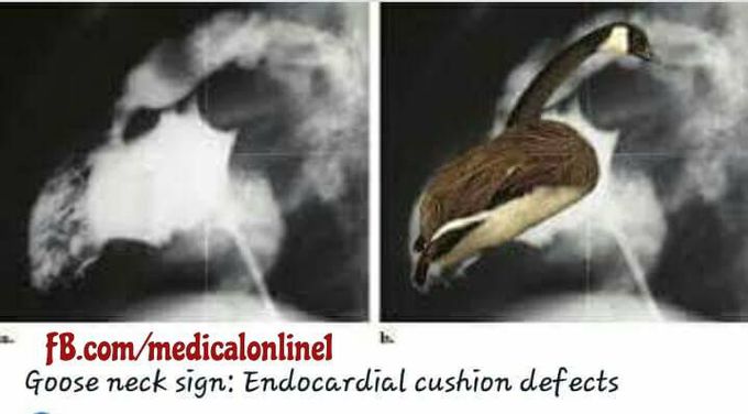 Cardic diseases