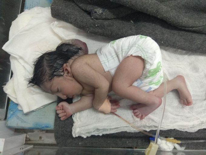 Meningomyelocele in gmc nagpur