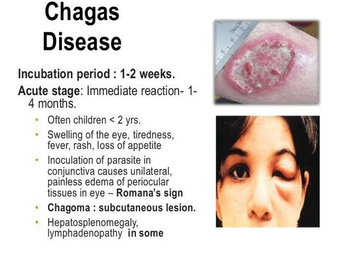 CHAGAS DISEASE - MEDizzy