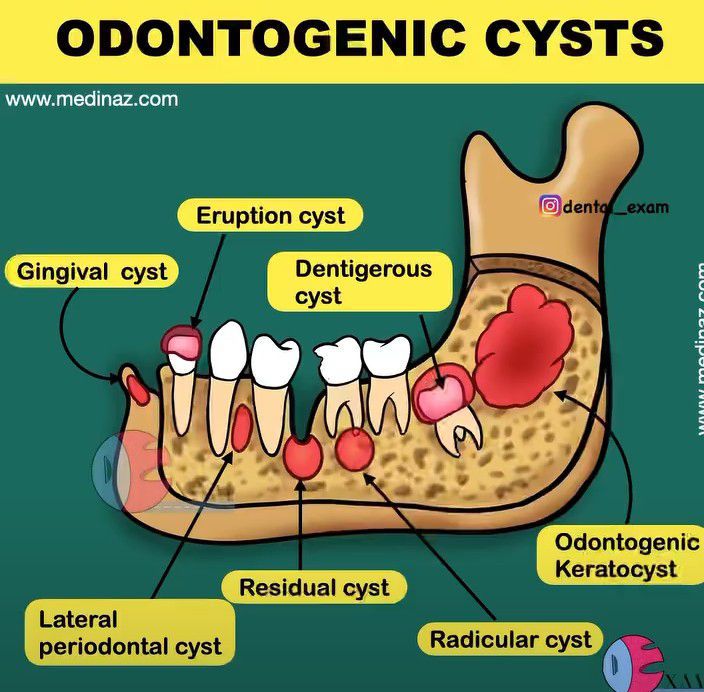 Odontogenic Cysts Medizzy