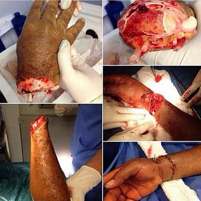 Reconstructive replantation of a severely damaged hand!