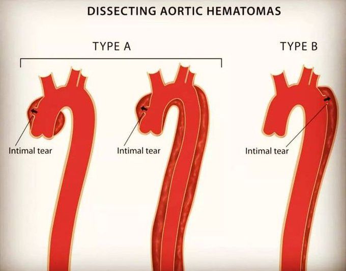 Dissecting Aortic Hematomas