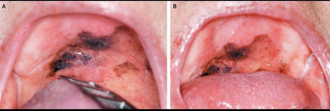 Melanoma of the Oral Cavity