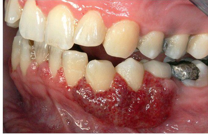 Wegener Granulomatosis