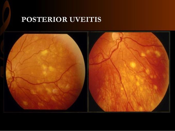 Sarcoidosis