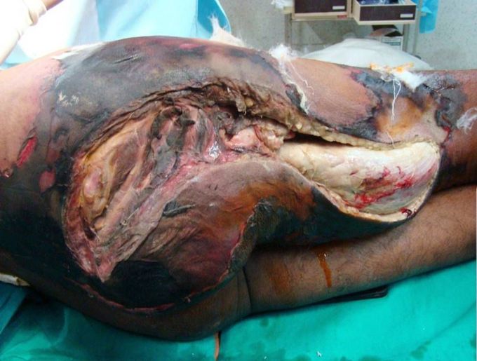 A previously healthy 56 years old male was brought with excruciatingly painful swelling of Rt lower limb, 2 days following trivial trauma to Rt foot.