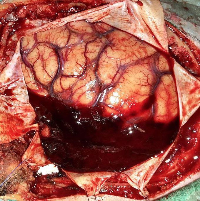 Exposing a subdural hematoma!  