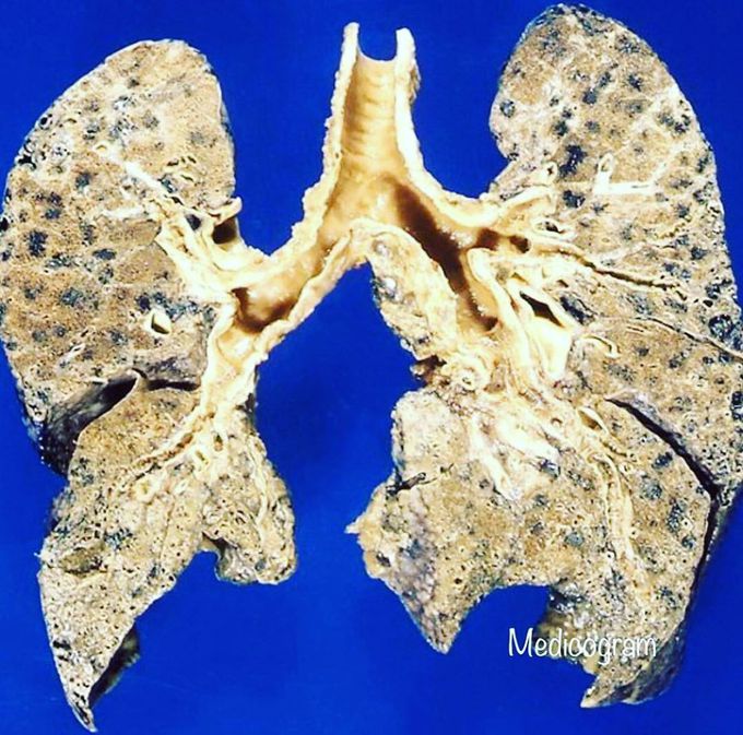 Emphysema