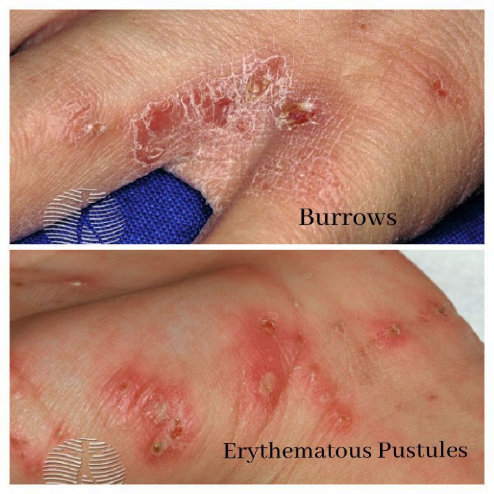 scabies burrows