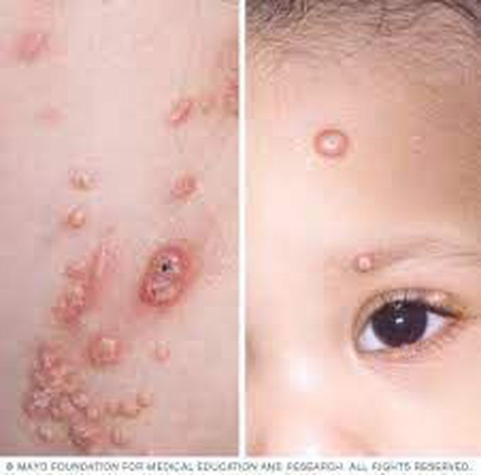 How to manage molluscum contagiosum