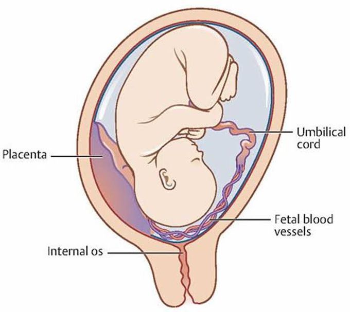 Sign and symptoms of vasa previa