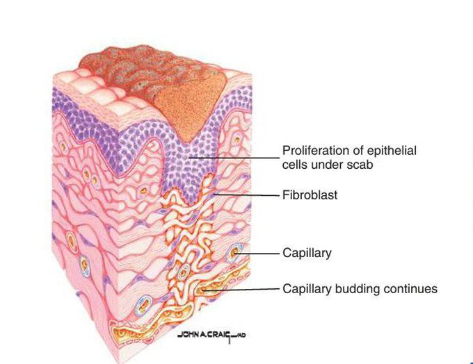 Fibroplastic stage of wound healing