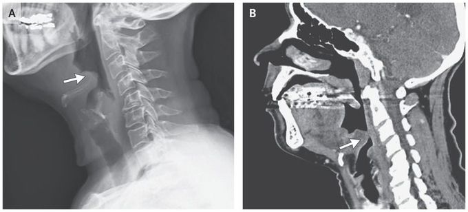 Epiglottitis in an Adult