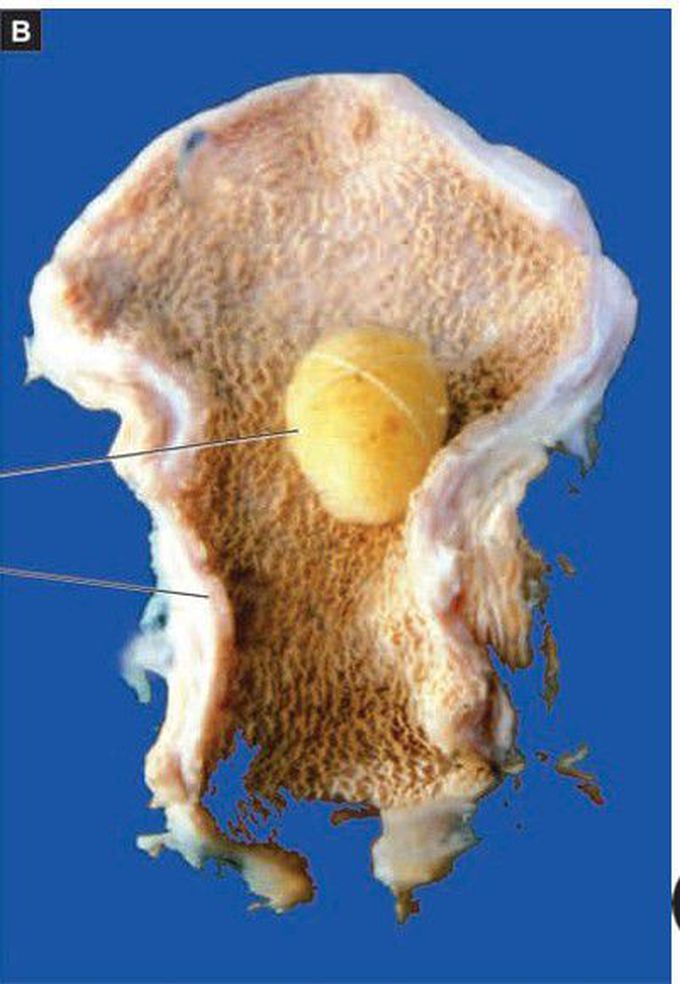 Chronic cholecystitis with cholelithiasis