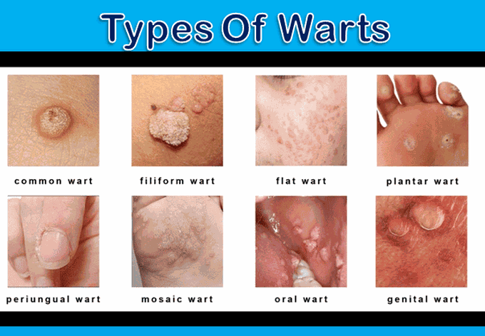 Types of warts