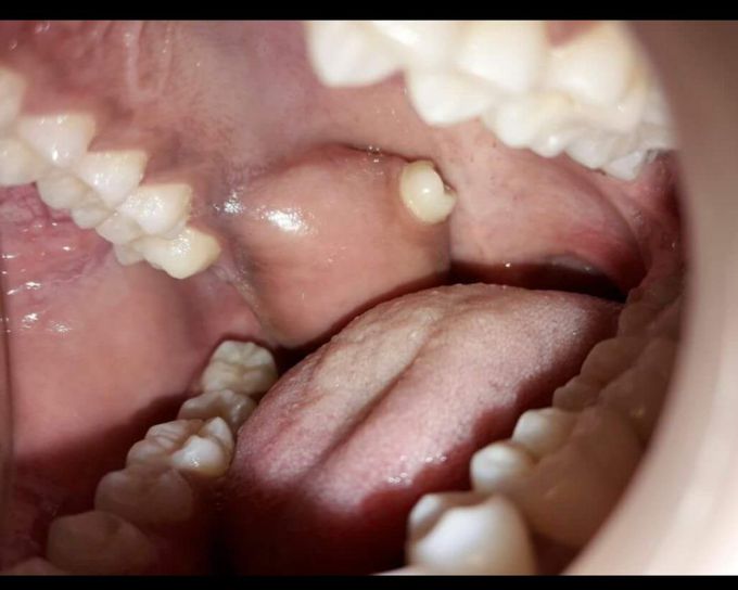 Ectopic tooth