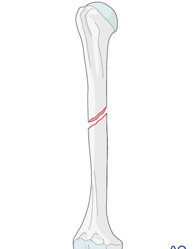 oblique fracture